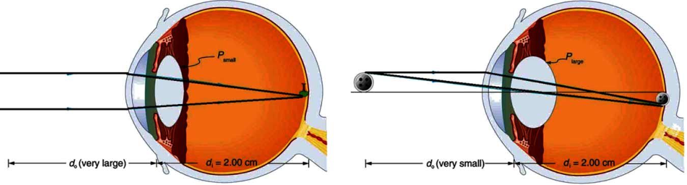 Diagram of eye for cataract surgery